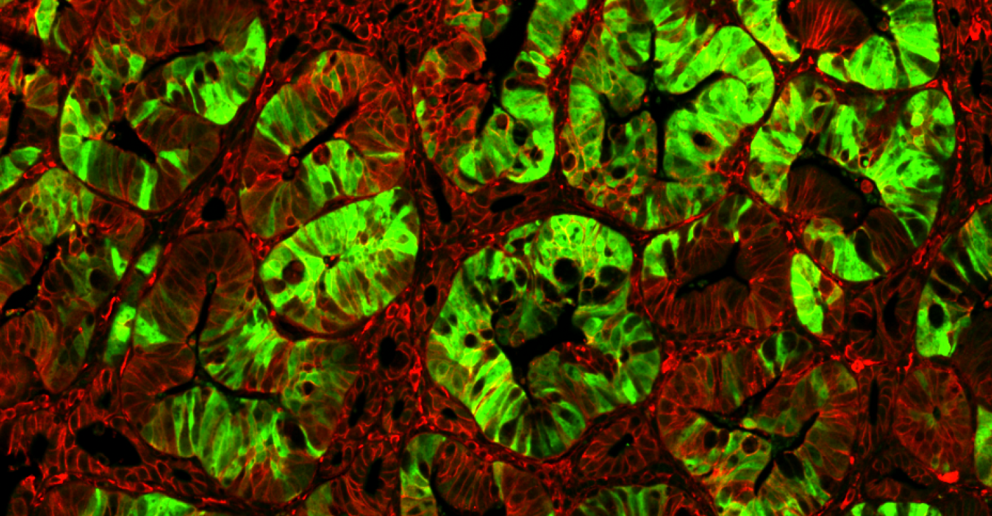 Expandierende Krebsstammzellen (grün) in einem Darmtumor mit onkogen aktiviertem Wnt/beta-Catenin Signalweg (rot). Bild: AG W. Birchmeier, MDC