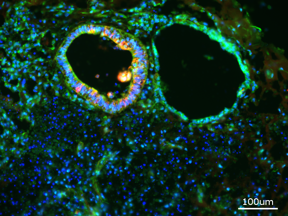 Bei SURF1-Organoiden sind die Bildung der Neuronen (rot) und die Verteilung der neuralen Vorläuferzellen (grün) gestört. © Dr. Rybak-Wolf, Organoide Plattform, MDC