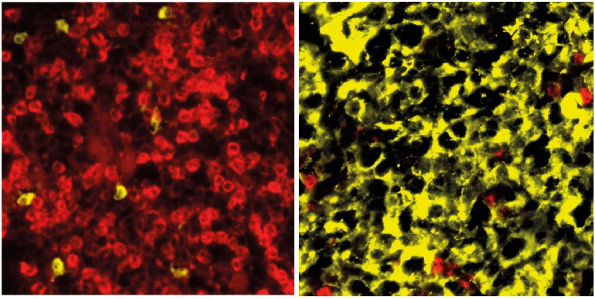 Links: Normales Knochenmark in den Kontrolltieren mit eingefärbten myeloischen Zellen. Rechts: Knochenmark in den transgeren Tieren mit Befall durch Plasmazellen. Bild: AG Janz, Max Delbrück Center