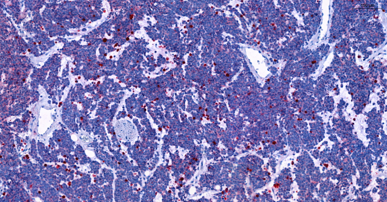 Rot eingefärbte, abgestorbene Zellen in DDX1-MYCN co-amplifizierten Neuroblastoma nach einer Rapamycin-Behandlung. Henssen Lab, Max Delbrück Center